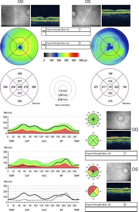 normal macular thickness oct